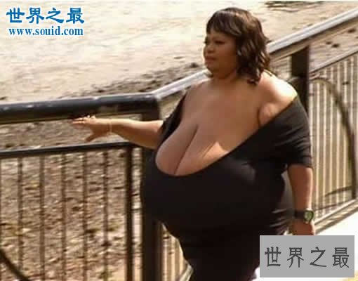 世界上最大的天然乳房,双乳重达77斤(图)