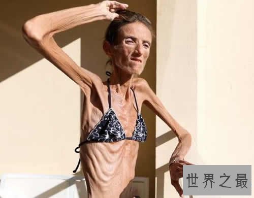 世界上最瘦的人,身高173厘米/体重只有27公斤(图)