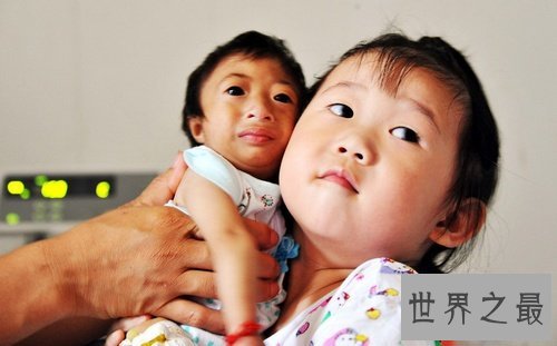 中国女童身高只有54厘米,可能是世界上最矮的人