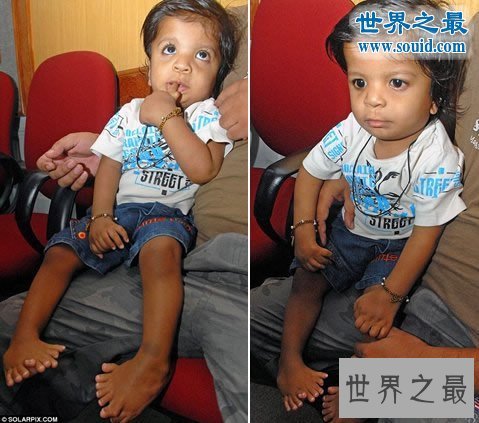 世界上手指脚趾最多的人,印度婴儿14个手指/20脚趾