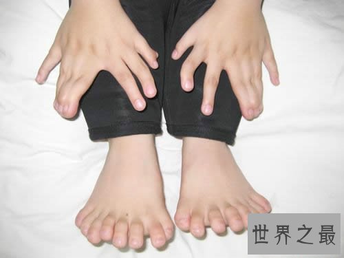 世界上手指脚趾最多的人,印度婴儿14个手指/20脚趾