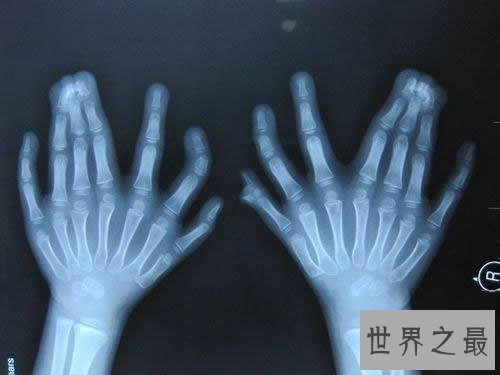 世界手指和脚趾最多的人，15个手指/16个脚趾