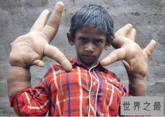 世界罕见巨指症男孩，被称恶魔之子(图)
