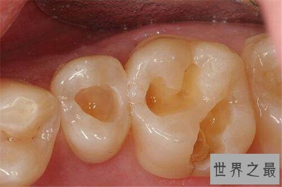 虫牙怎么办?长期清洁不当则会造成牙齿损坏