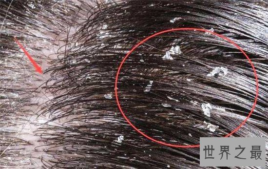 怎样去头皮屑？制定一个合理的治理方法