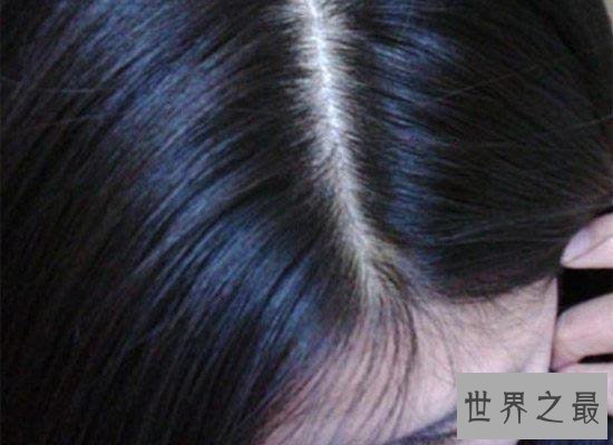 头皮发麻是怎么回事？可用冷水洗澡来缓解