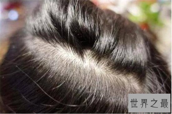 头皮发麻是怎么回事？可用冷水洗澡来缓解