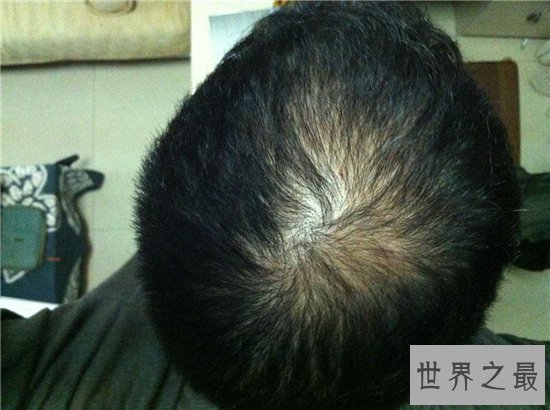 头皮发麻是怎么回事？可用冷水洗澡来缓解