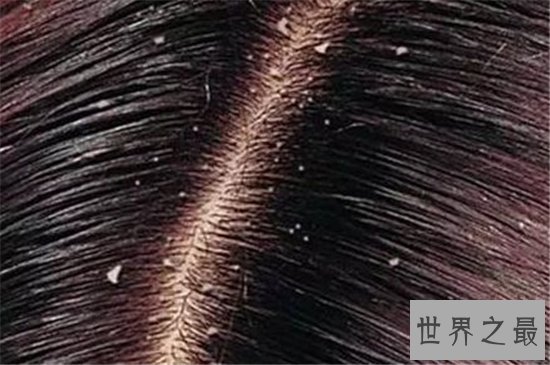 头皮痒怎么办？多种原因让你改善头皮问题