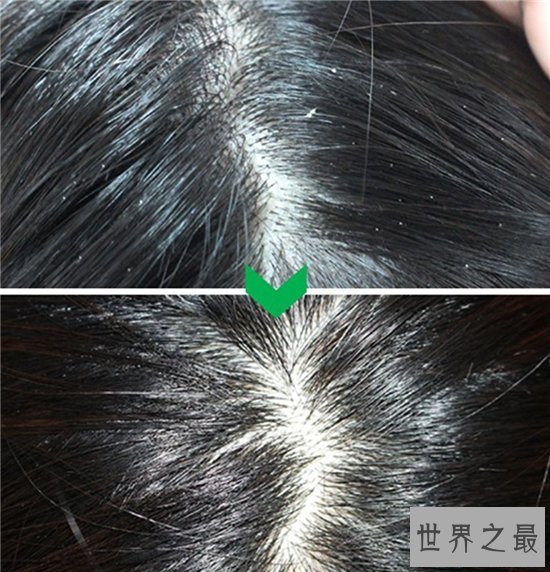 头皮痒怎么办？多种原因让你改善头皮问题