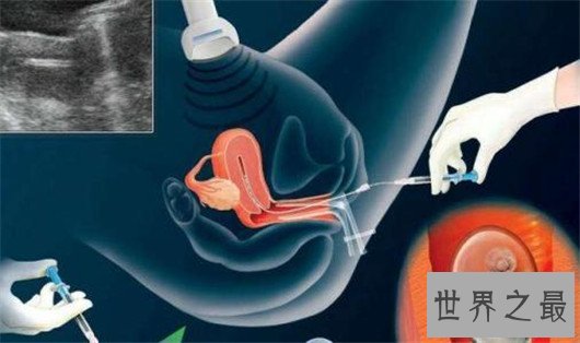 试管婴儿虽是不孕症的救星,但费用昂贵无力承担