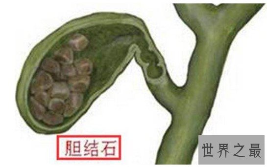世界上最大的人体胆结石,重达12.58千克