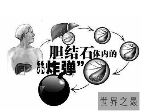 世界上最大的人体胆结石,重达12.58千克
