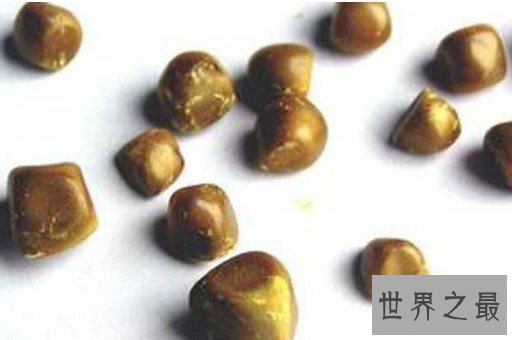 世界上最大的人体胆结石,重达12.58千克