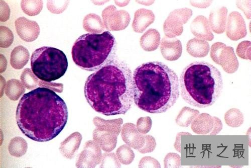 世界五大绝症,患有几种绝症就离死亡不远了
