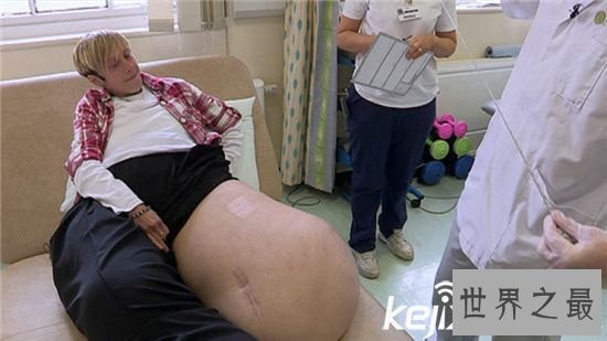 世界上最大最重的腿,英国女子腿重216斤