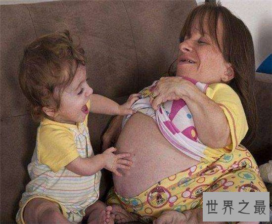 世界最小母亲斯泰西.赫拉尔德,天生患有脆骨病