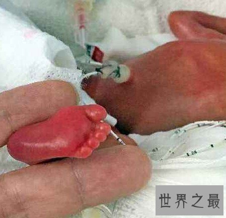 世界上最小的婴儿,还没有一支笔大