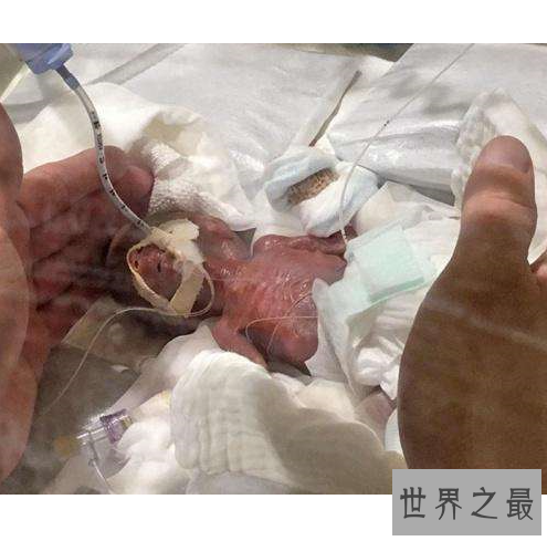 世界上最小的婴儿,体重只有250克和一个鸡蛋一样重。
