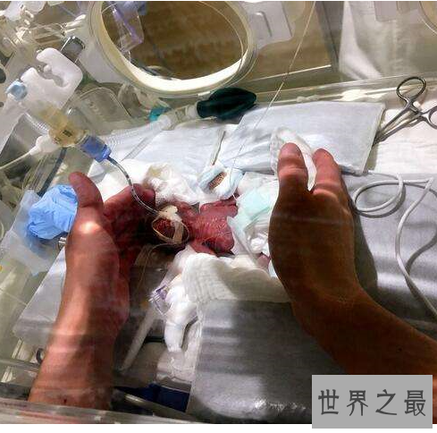 世界上最小的婴儿,体重只有250克和一个鸡蛋一样重。