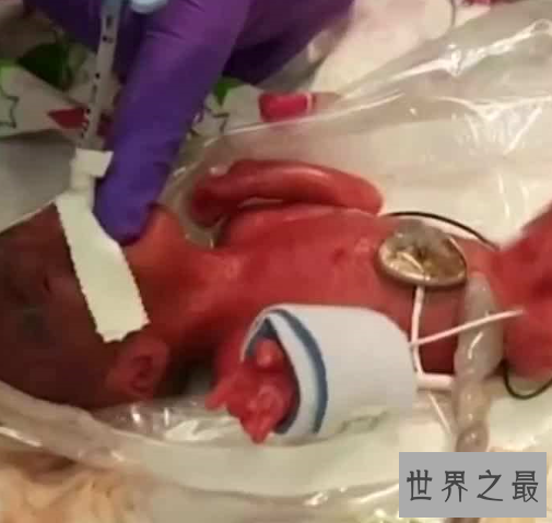 世界上最小的婴儿,体重只有250克和一个鸡蛋一样重。
