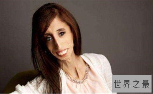 世界上最瘦的人,减肥过度宛如干尸(体重仅20公斤)