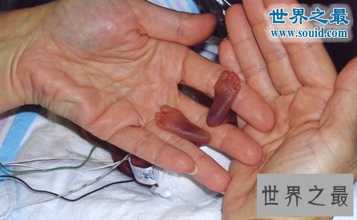 世界上最小的婴儿,五胞胎中最小孩子仅250克