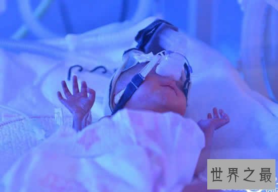 世界上最小的婴儿,五胞胎中最小孩子仅250克