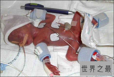 世界上最小的婴儿,五胞胎中最小孩子仅250克