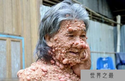 神经纤维瘤