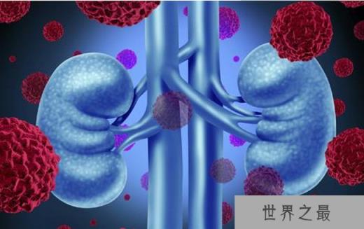 尿毒症