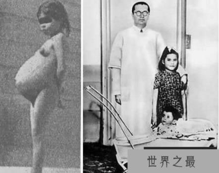 世界上最年轻的妈妈，秘鲁5岁女童生子，成年龄最小的妈妈
