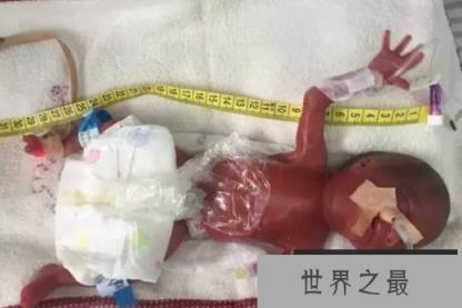 世界上最小的婴儿：阿米利娅·泰勒，体重仅280克(图2)