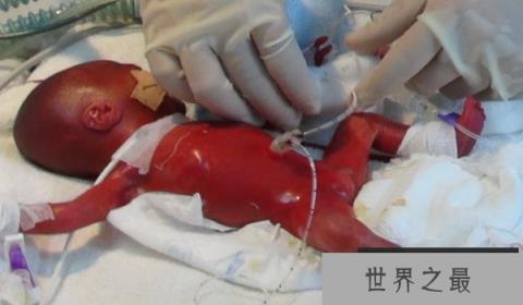 世界上最小的婴儿：阿米利娅·泰勒，体重仅280克(图3)