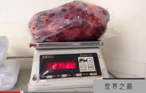 世界上最大的肾脏