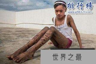 世界十大罕见病:一种变成活死人一种变成蓝血人