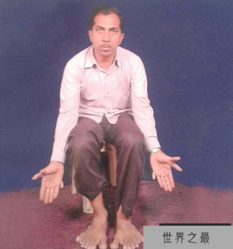 世界之最：印度男子有28根手指脚趾
