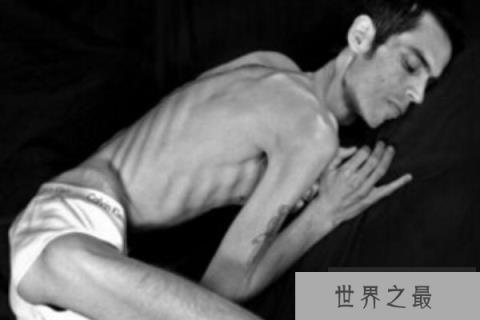 世界最瘦的男人：骨瘦如柴，体重仅41公斤