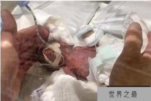 世界最小男婴 重量仅268克已平安出院(体重最轻)