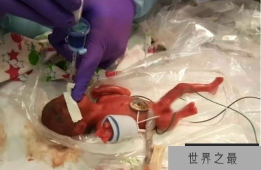 世界最小男婴 重量仅268克已平安出院(体重最轻)