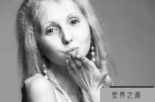世界上最瘦的女性 俄罗斯少女仅为20公斤(因厌食症)