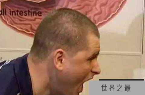 世界上打嗝时长最长的人 美国查尔斯.奥斯 (一种怪病) 世界上打嗝时长最长的人 美国查尔斯.奥斯 (一种怪病)