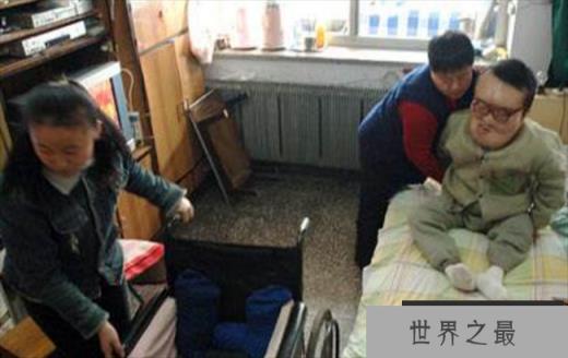 世界上最大的头 来自吉林的孙祥明 (异样增生症)