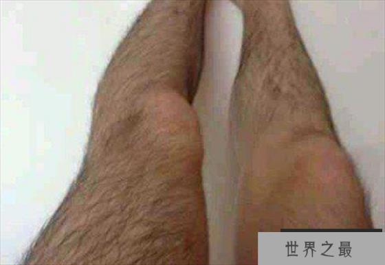 世界上最长的腿毛 长到了22.46厘米(杰森·艾伦)