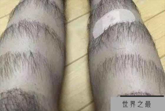世界上最长的腿毛 长到了22.46厘米(杰森·艾伦)