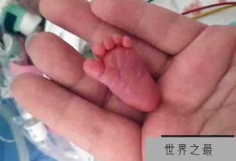 世界上体重最轻的婴儿 出生时只有280克(身高25厘米)