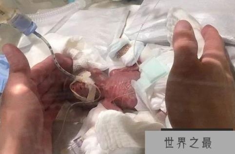 世界上体重最轻的婴儿 出生时只有280克(身高25厘米)