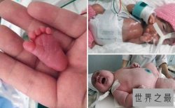 中国最小婴儿体重950克，贵州产妇妊娠30周产下（婴儿仅巴掌大小）