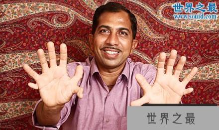 世界上最多的手指和脚趾,一共有28根(www.1357vip.com)