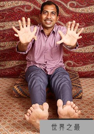 世界上最多的手指和脚趾,一共有28根(www.1357vip.com)